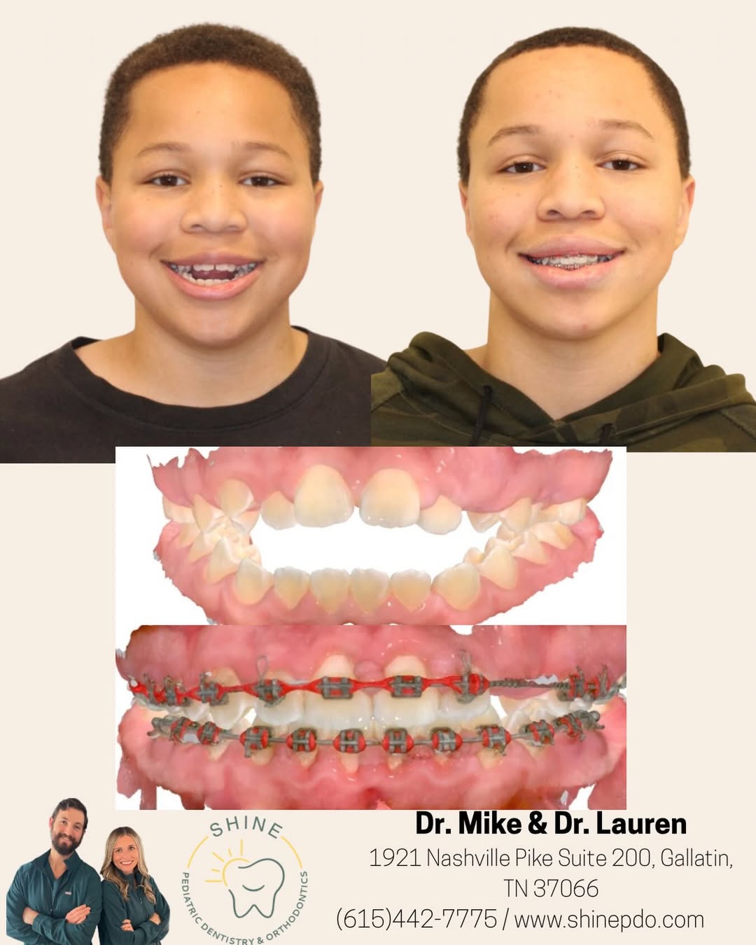 before:after shine pdo