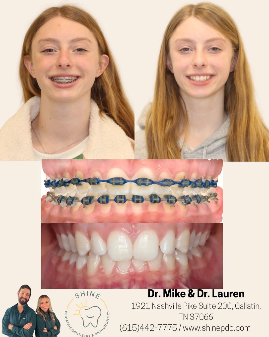 shine pdo before:after 2