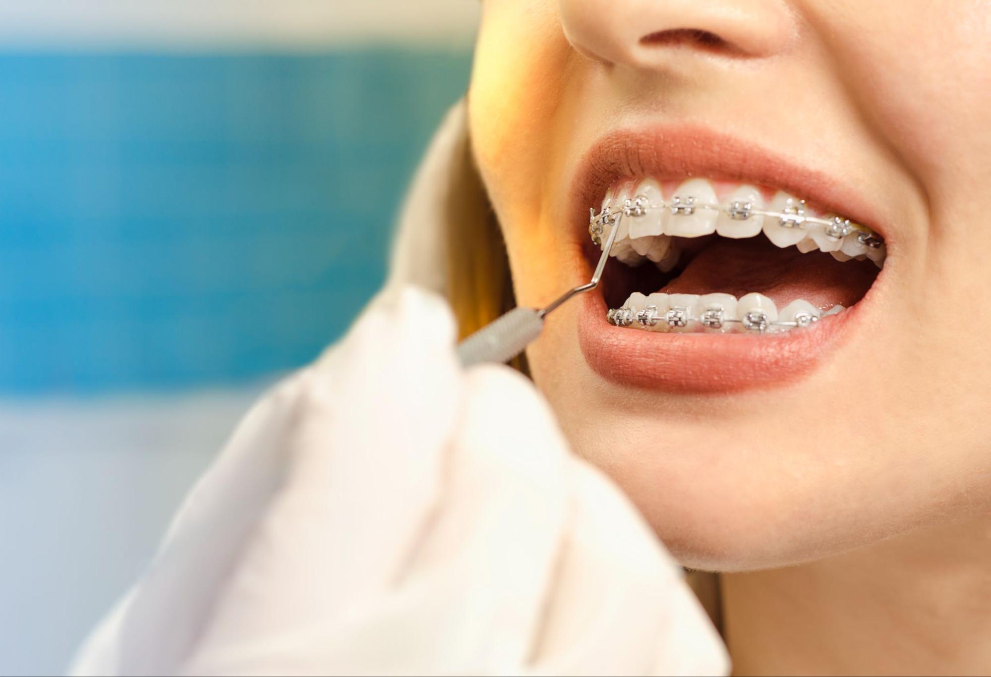 WildSmiles vs. Traditional Metal Braces: Which One Is Right for Your Child?